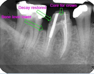 Crown lengthening example