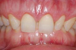 Crown lengthening example