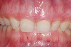Crown lengthening example