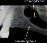 Sinus graft example